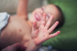 Herpangina, Mundfäule, Hand-Mund-Fuß-Krankheit bei Kindern
