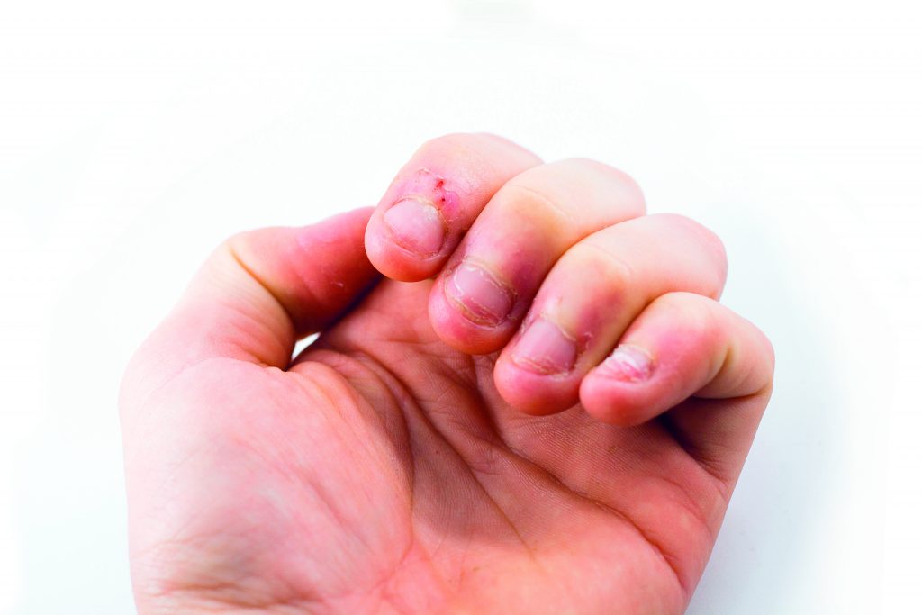 ursachen nägelbeißen