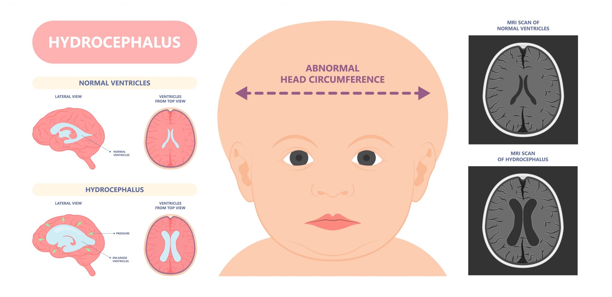 Hydrocephalus,Brain,Cerebrospinal,Fluid,(csf),Drain,Head,Spina,Autism,Cerebral