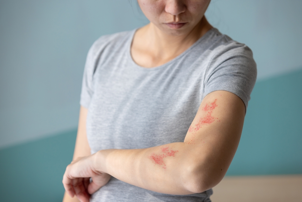 Woman,With,Shingles,On,The,Skin,She,Feels,Very,Painful